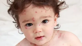 ما هي أعراض الجدري عند الأطفال