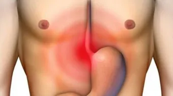 ما هي أعراض القرحة المعدية