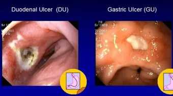 ما هي أعراض القرحة في المعدة
