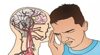 ما هي أعراض الجلطة الدماغية