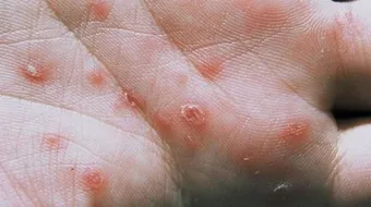 ما هي أعراض الزهري