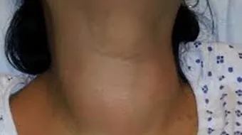 ما أعراض الغدة الدرقية