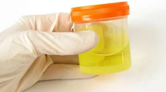 ما هي أعراض زلال البول