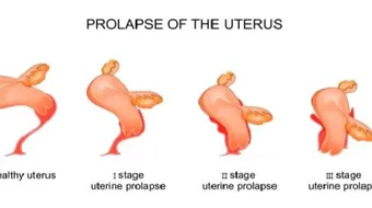 ما هي أعراض نزول الرحم