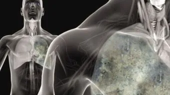 ما هي أعراض المياه على الرئة