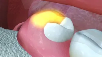 ما هي أعراض ألم ضرس العقل