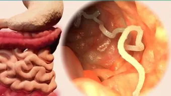 ما هي أعراض الديدان