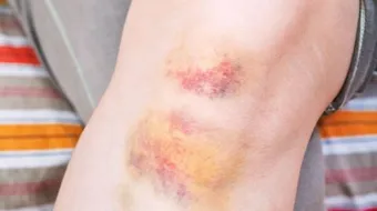 ما سبب خشونة الركبة