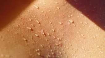 ما سبب تعرق اليدين والرجلين