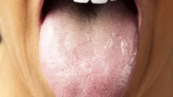 ما سبب تشقق اللسان