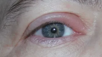 ما أسباب انتفاخ الجفن العلوي للعين