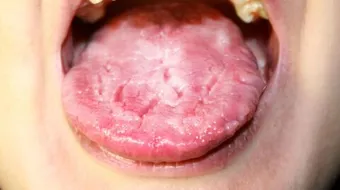 ما سبب تقرحات اللسان