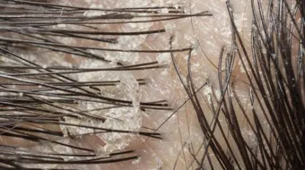 ماذا تفعل القشرة في الشعر