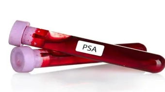 ماذا يعني فحص PSA