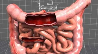 ماذا يأكل مريض القولون