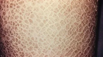 ما هو مرض التسمك الشائع