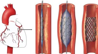 ما هي قسطرة القلب