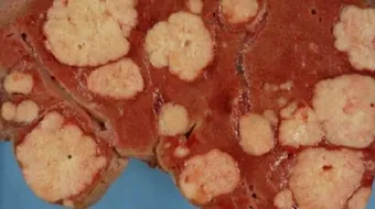 ما هو ورم الكبد