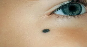 ما هي الشامة