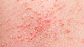 ما هو الطفح جلدي