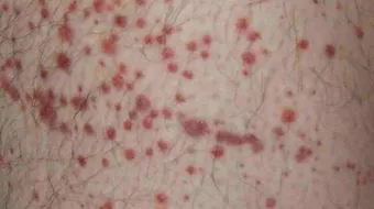 ما هو الطفح الجلدي