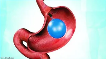 ما هو بالون المعدة