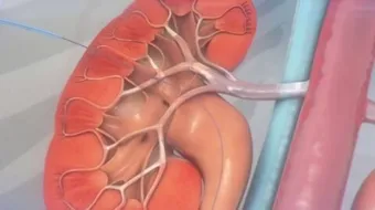 ما هي قسطرة الحالب