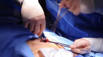 ما هو فتق البطن