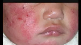 ما هي حساسية الارتكاريا