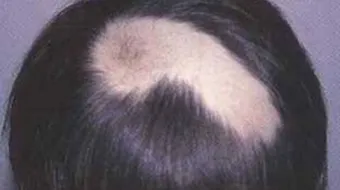 ما هى الثعلبة وما علاجها