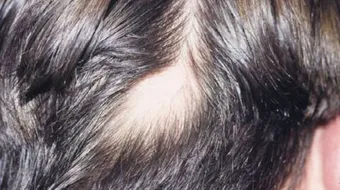 ما هي الثعلبة