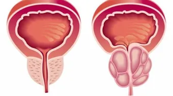 ما هو تضخم البروستاتا