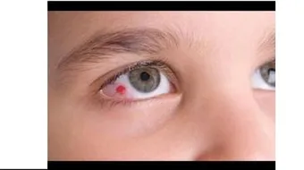 ما هو ظفر العين