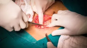 ما هي الزائدة الدودية