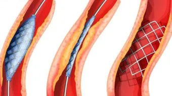 ما هو تصلب الشرايين