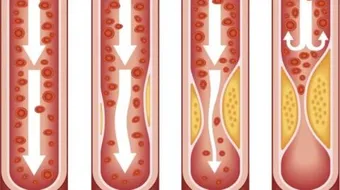 ما هو مرض تصلب الشرايين