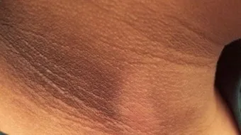 ما هو مرض الشواك الأسود و ما أسبابه