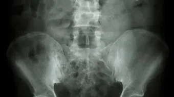 ما هو تكلس العظام