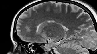 ما هو نزيف المخ