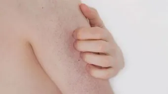 ما هو مرض التقرن الشعري