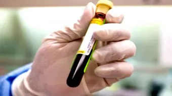 ما هو تحليل CBC