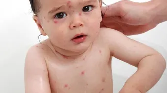 ما هو جدري الماء