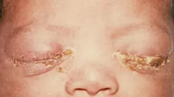 ما هي الكلاميديا