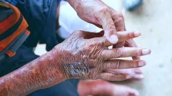 ما هو تليف الجلد