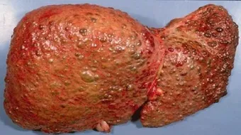 ما هو تليف الكبد