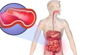 ما هو داء كرون