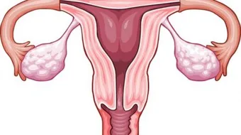 ما هي بطانة الرحم المهاجرة