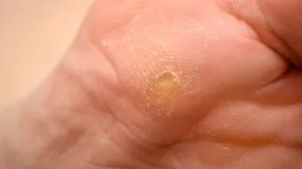 ما هو علاج عين السمكة