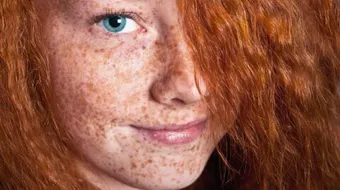 ما هو النمش