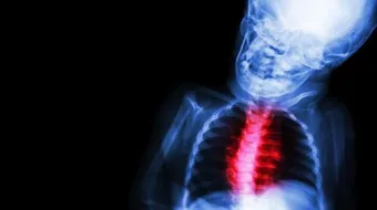 ما هو روماتيزم القلب